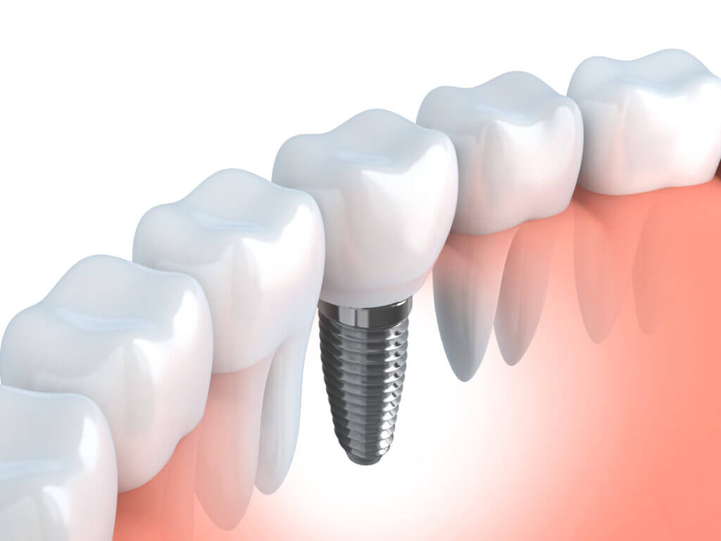 Colocación de implante dental