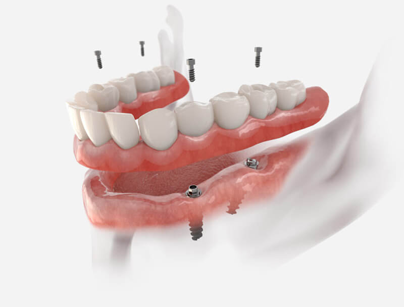 Prótesis dentales en Mirasierra